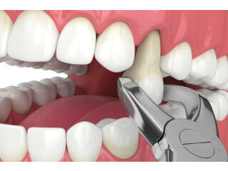 Dental Abscesses