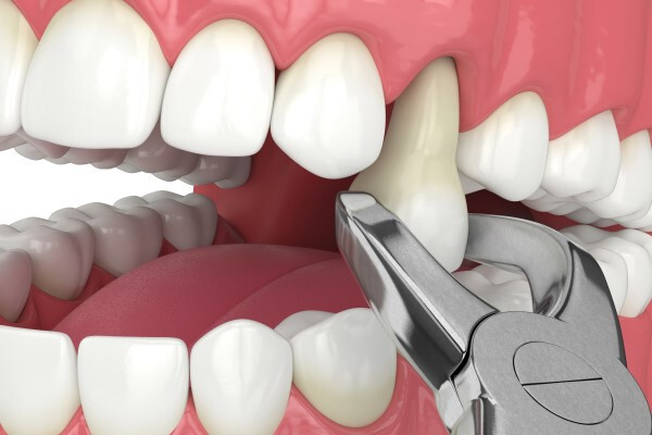 dental-abscesses-big-0
